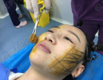 女子线雕手术三年后脸上钻出一根线，揭秘美容手术风险与后果