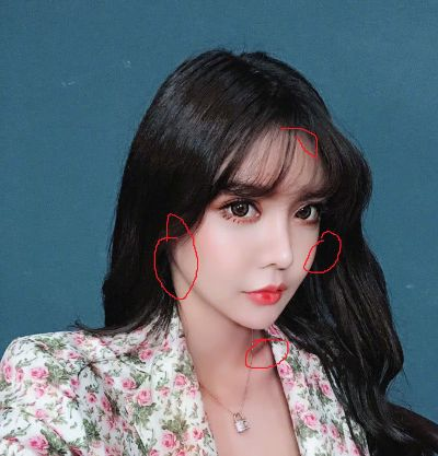 韩安冉抽脂术后留下七八个疤点，揭秘网红整形背后的风险与代价