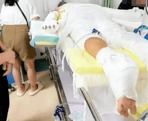 女子安装燃气罐意外爆炸，全身75%烧伤，悲剧警示燃气安全不容忽视